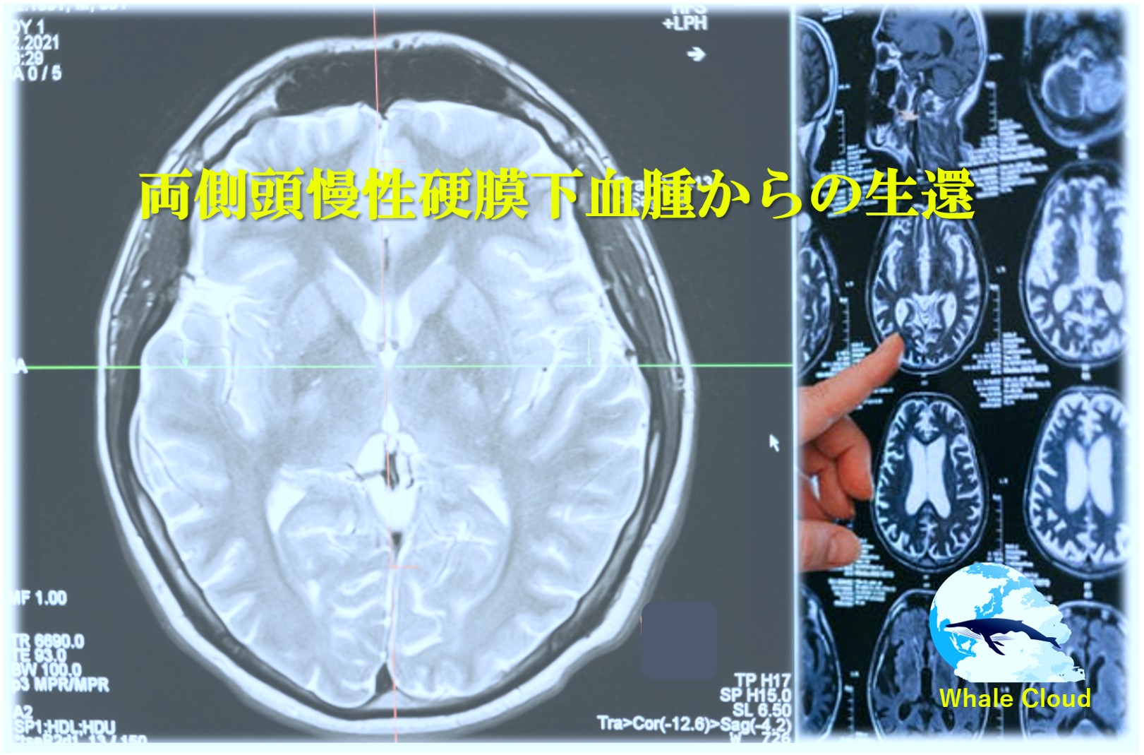 両側頭慢性硬膜下血腫からの生還